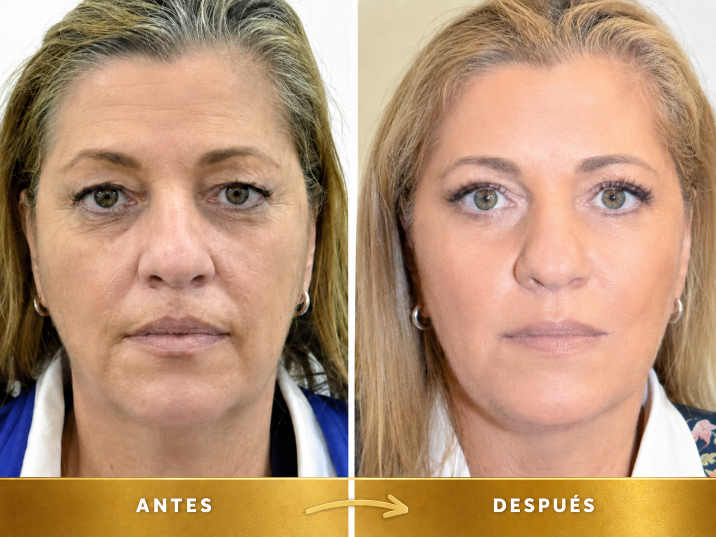Comparativo antes y después usado en el análisis